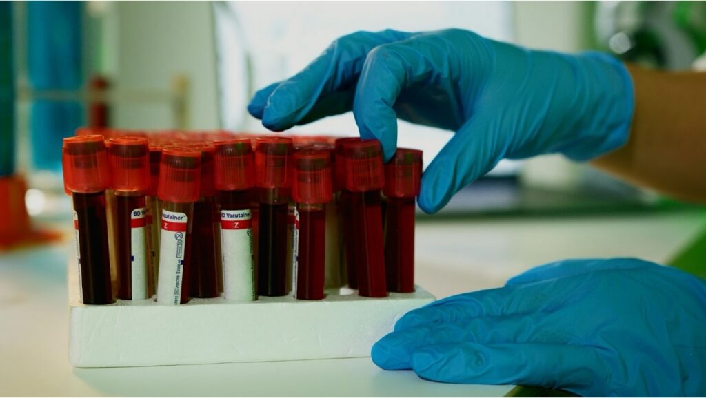 A close-up shot of medical test tubes filled with blood samples in a white rack